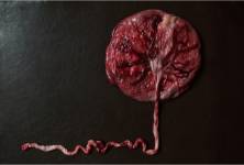 Pupečníková krev – proč se odebírá a k čemu slouží